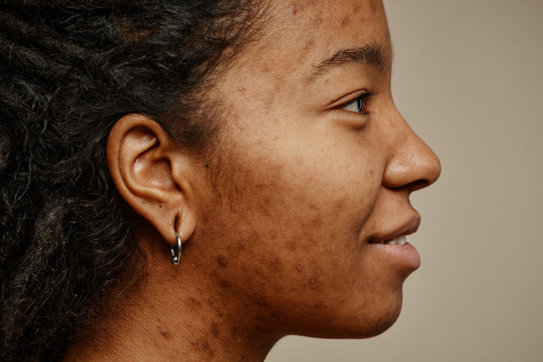 Young woman with hyperpigmentation on brown skin — Amaranth by Agaja