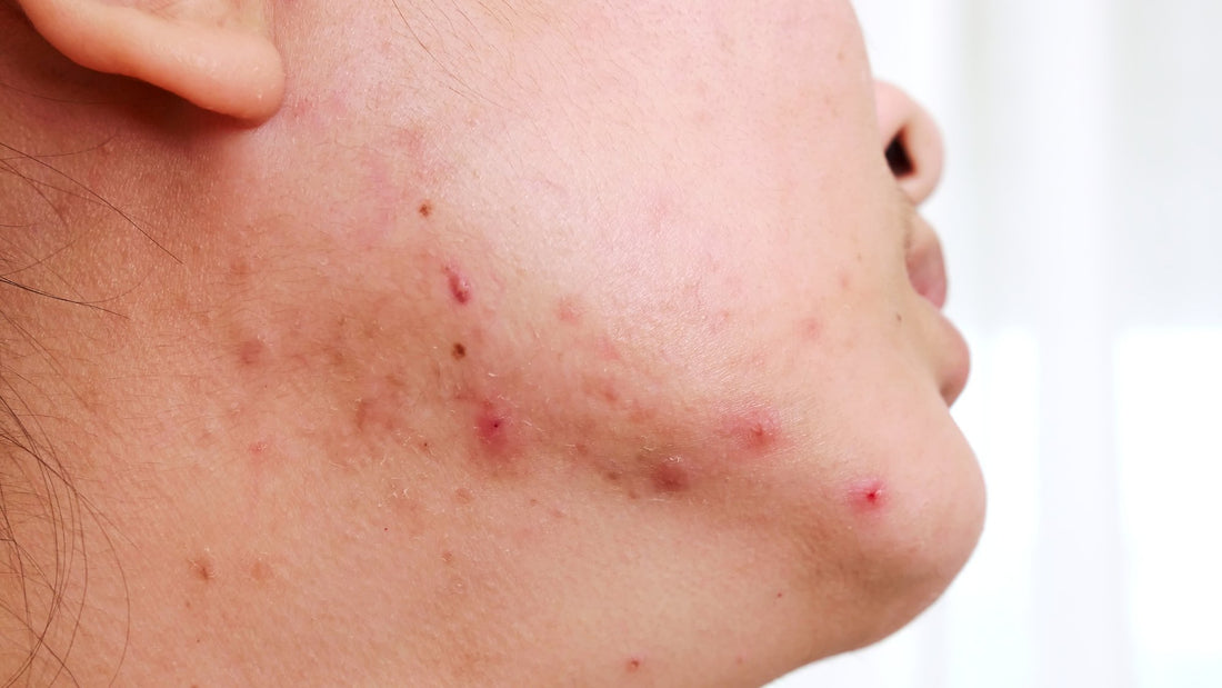 Stress acne — the loop between breakouts and cortisol
