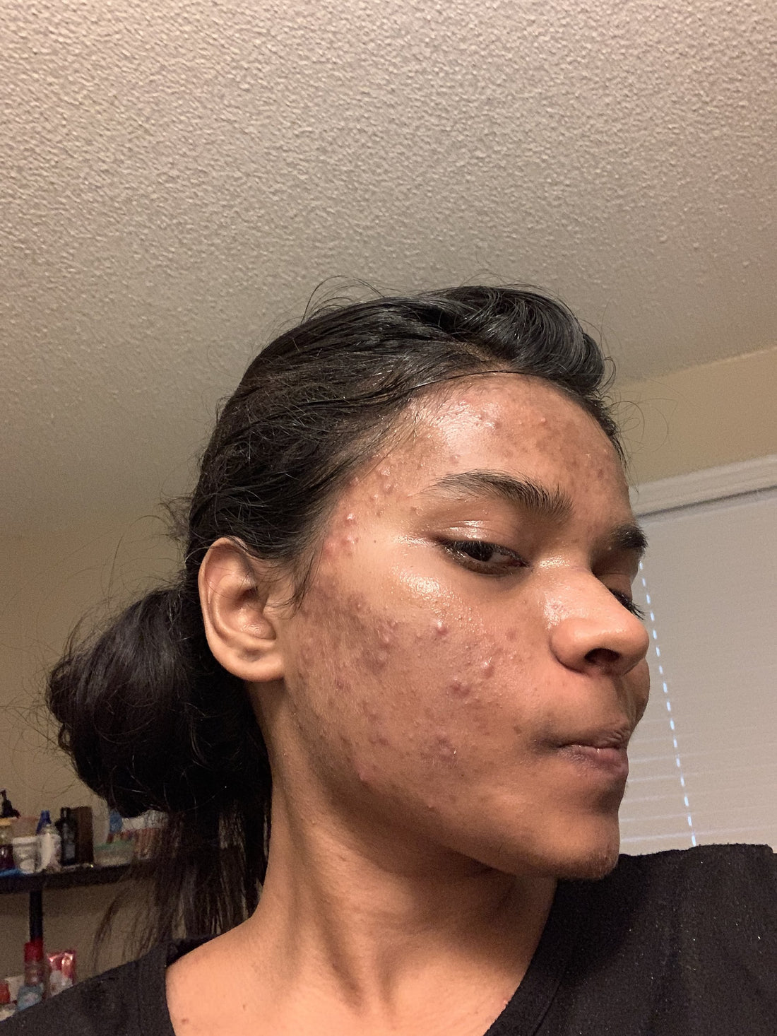 Agaja in 2019 with hormonal acne — founder of Amaranth by Agaja